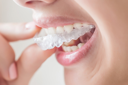 Do I really need to wear a retainer after braces?