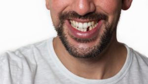 Adding a “pontic” tooth during Invisalign treatment