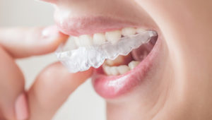 Do I really need to wear a retainer after braces?
