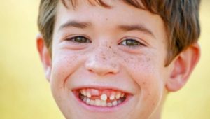 What if my child is missing teeth?