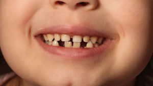 How young is too young for orthodontic treatment?