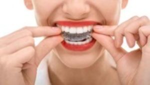 The straight scoop: Choosing between traditional braces and Invisalign