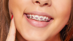 Do Braces Hurt?