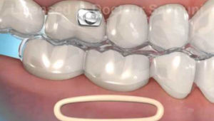 Rubber bands and orthodontics