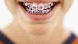 What color are your braces?