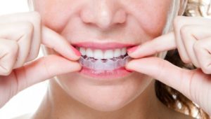 How does Invisalign work?