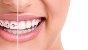 What’s the cost difference between traditional braces and Invisalign?