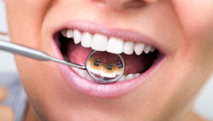 Are lingual braces the best option?