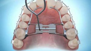 Braces 101: Do I really need an expander?