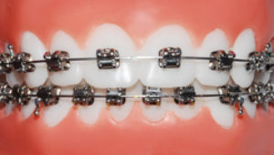 SmartClip Brackets