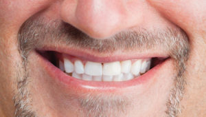 After the braces: Keeping teeth straight