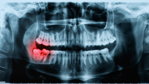 Wisdom Teeth Eruption