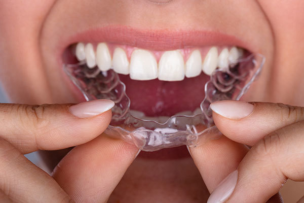 Getting ready for an implant: Invisalign goes beyond straightening teeth